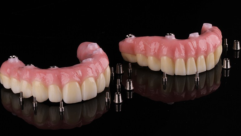 Циркониевый зубной ряд с реалистичной имитацией десны для протезирования на имплантатах