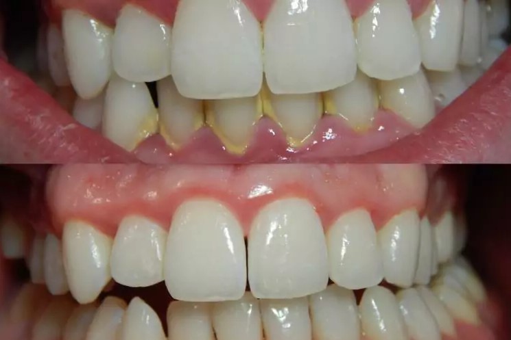 зубной камень на зубах фото