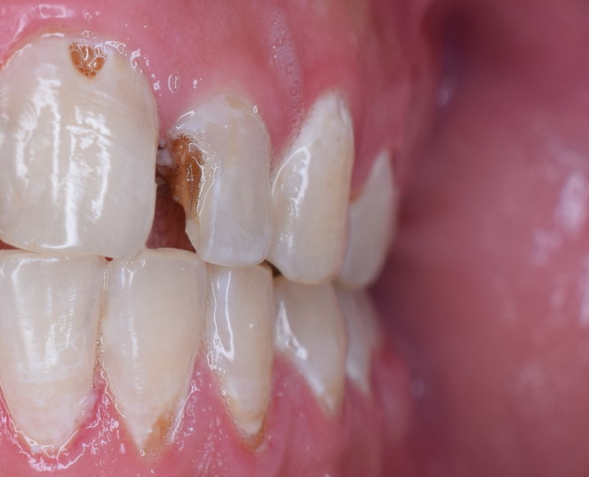 наращивание зубов до и после фото