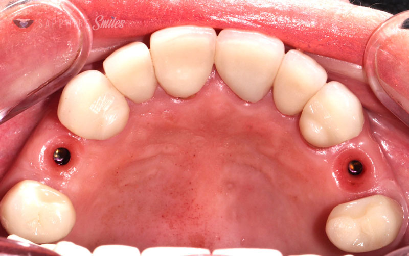 одномоментная имплантация зубов фото
