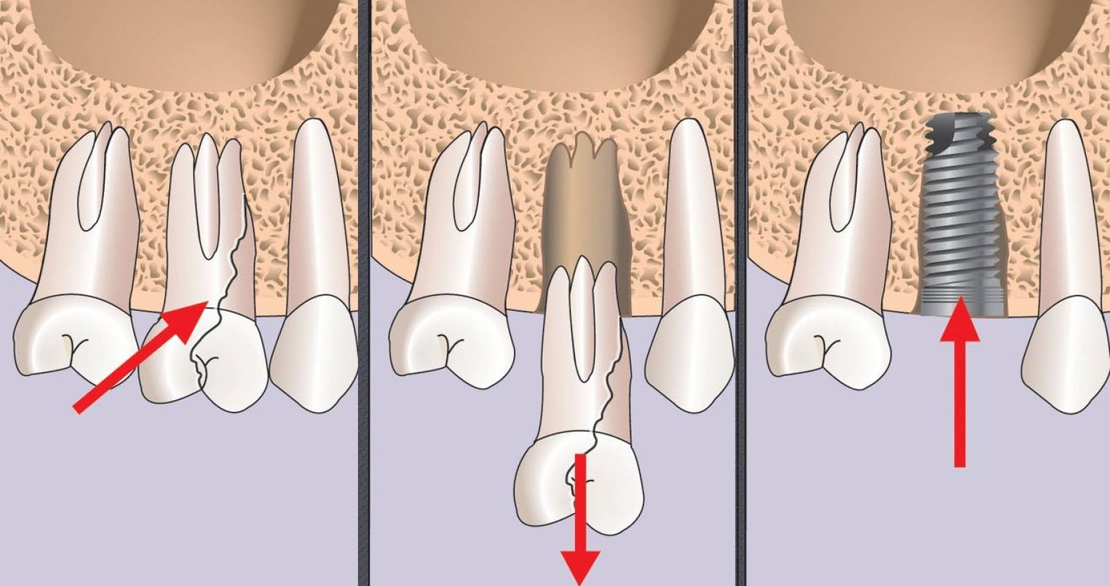 имплантация зубов фото