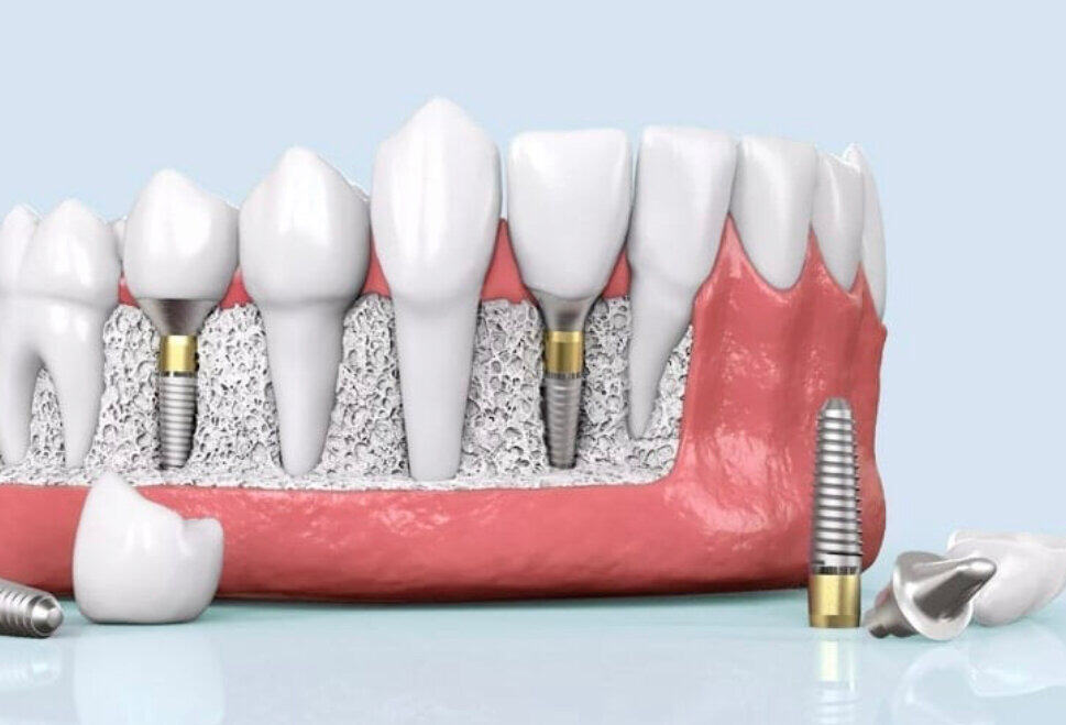 этапы имплантации зубов фото