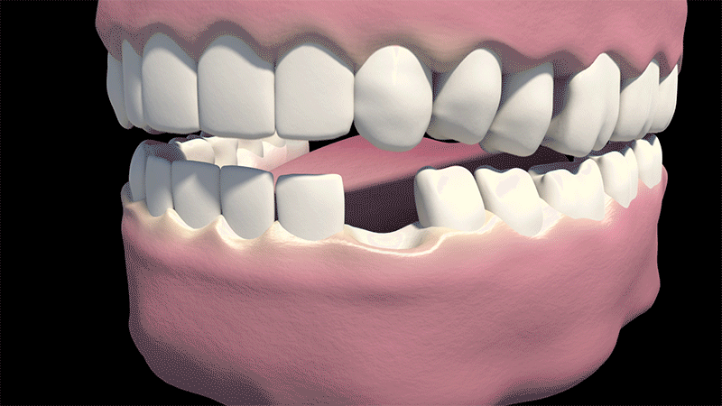 имплантация передних зубов фото